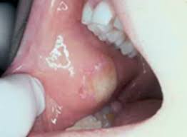 Most gum cancers form right on the gum surface and are a type of skin cancer known as squamous cell carcinoma. Oral Cancer Images The Oral Cancer Foundation