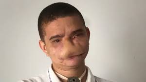 Pasé años escondiéndome": el joven alcanzado por fuegos artificiales que  sueña con reconstruir su rostro