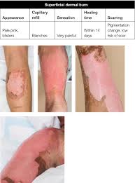Dark patches of dead skin on the wound surface can be alarming to an individual who is recuperating from a burn wound or a diabetic ulcer, but this tissue, also known as eschar, is a normal part of the healing process. Racgp Burns Dressings