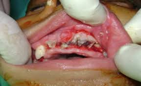Its contemporary face and management. Maxillary Osteomyelitis By Mucormycosis Report Of Four Cases International Journal Of Infectious Diseases