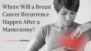 A breast cancer diagnosis can come as a shock to patients, especially if they were misdiagnosed. Where Will A Breast Cancer Recurrence Happen After A Mastectomy Youtube
