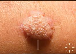 Image result for verrucae filiformes