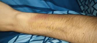 Image result for spinne biss haut reaktion