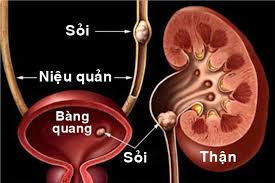 Bệnh sỏi thận
