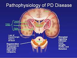 The cause of pd is not known, but a number of genetic risk factors have now been characterized, as well as. Drugs Used In Parkinsons Disease Parkinsons Disease Parkinsonism