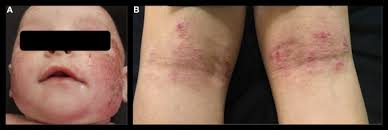 Image result for dermatitis contacta children