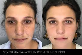 Preparing for microneedling at home download article. Hyperpigmentation Archives Slk Clinic