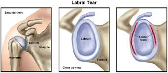 Diagram of the human shoulder joint, back view. Physical Therapy Guide To Shoulder Labral Tear Choosept Com