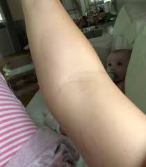 Robert svedin (@robert_svedin) • instagram photos and videos. Jonna Lundell Was Forced To Visit A Doctor Was Worse And Worse Halids