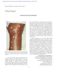 Some authors recommend the use of thrombolytic therapy in patients with meningococcal purpura fulminans and shock, in an attempt to reverse established widespread small vessel thromboses that have occurred in the setting of elevated pai‐1 levels. Pdf Infectious Purpura Fulminans