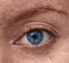 7 the incidence for eyelid scc has been reported to be between 0.09 and 2.42 cases per 100 000 population with higher prevalence in males, in the lower lid (especially the medial canthal region), in fair skin. Q A Skin Cancer Of The Eyelid Moffitt