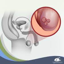 International Surgery En Twitter El Cancer De Testiculo Es El Tipo De Cancer Mas Frecuente En Hombres De Los 15 A Los 35 Anos De Edad Entre Los Sintomas Se Encuentran Bolita