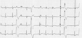 Ecg In A Basketballer Showing Multiple Premature Ventricular Complexes Download Scientific Diagram