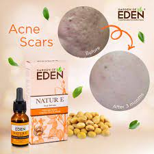 Review serum terbaik di malaysia | serum nacific vs serum garden of eden. Garden Of Eden Natur E Scar Serum 5ml Alpro Pharmacy