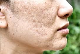 The toughest form of acne scarring is a result of severe inflammation destroying the collagen in the deeper layers of skin. How To Get Rid Of Cystic Acne Home Remedies Treatment Causes