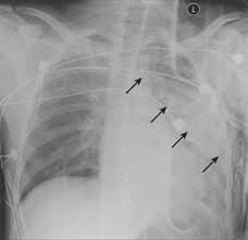 Image result for Pulmonary Contusion