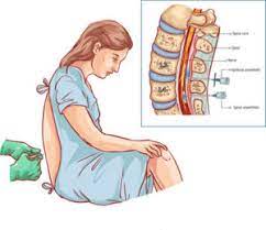 Epidural Steroid Injections Spine Institute Of Arizona