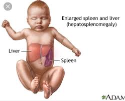 Color Of Healthy Baby Color Of Baby With Liver Disease Gaucher S Disease Liver Disease Healthy Babies