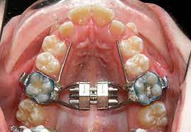This Was One Of The Worst Feelings I Ve Ever Had To Endure It S A Mouth Expander To Make Room For Teeth When You Get Braces Teeth Braces Dental Braces Orthodontics