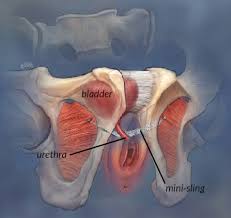 His bladder's probably smaller than yours. Mid Urethral Sling Mus Procedures For Stress Incontinence Your Pelvic Floor