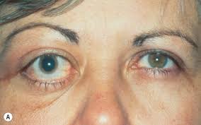 The idiopathic inflammatory myopathies (iims) are a heterogeneous group of diseases, collectively termed myositis, sharing symptoms of muscle weakness, fatigue and inflammation. Orbital Disease In Neuro Ophthalmology Sciencedirect