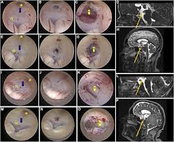 Dorsum Sellae as Key Landmark in ETV With Disminished Prepontine Cistern:  Technical Note and Case Series