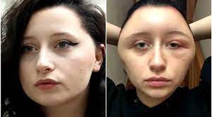 In third time i felt something sticky mass surrounding hairs of my mustache the other day. French Woman S Head Transforms Into Light Bulb After Near Fatal Reaction To Hair Dye Trending News The Indian Express