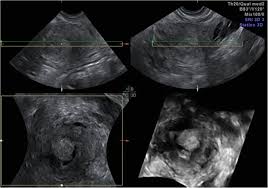 There are many signs of endometrial cancer a woman might experience. Endometrial Cancer An Overview Of Novelties In Treatment And Related Imaging Keypoints For Local Staging Cancer Imaging Full Text