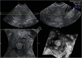 That's why new guidance from the national institute for health and care excellence (nice) recommends that if you're diagnosed with endometrial cancer, you should be offered testing for lynch syndrome. Endometrial Cancer An Overview Of Novelties In Treatment And Related Imaging Keypoints For Local Staging Cancer Imaging Full Text