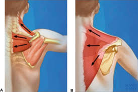 Image result for Winged Scapula