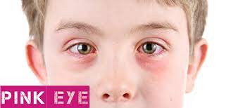 Did You Know That More Than 3 Million Cases Of Pink Eye Or Conjunctivitis Is Diagnosed Each Year If Your Child Has Pink Eye Pink Eyes Watery Eyes Eye Health