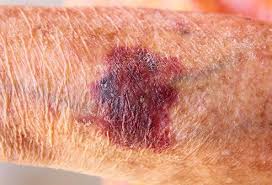 They can appear on the skin of body organs such as eyes, nose, mouth cavity, arms, legs or any other parts of your body. Actinic Purpura Vs Senile Purpura