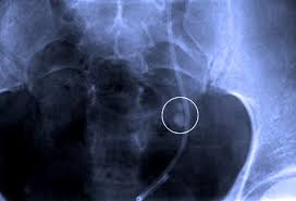 Kidney Stone Crystal Picture Image On Medicinenet Com