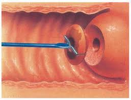 Cuando la lesión sea endocervical y no se visualice el límite superior de la misma, se debe realizar cubo endocervical y legrado del endocérvix. Http Www Aepcc Org Wp Content Uploads 2018 04 Ais Pdf