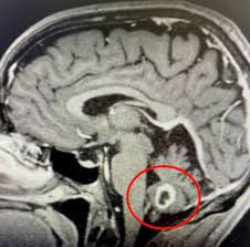 Image result for Brain Abscess