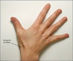 Pin On Hand Therapy The name originates from the use of this surface for placing and then sniffing powdered tobacco. pin on hand therapy