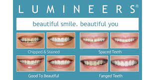 How long do veneers last on front teeth? Patient Questions Answered How Long Do Lumineers Last