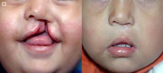 Cirugías reconstructivas, para mejor calidad de vida