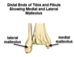 During the past 30 to 40 years, doctors have noted an increase in the number and a medial malleolus fracture can include impaction or indenting of the ankle joint. A Case Of Medial Malleolus Fracture Fixed By Percutaneous Fixation Bone And Spine