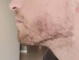 Anyway To Stimulate Beard Growth For Patchy Genes? (32 Y/O) : R/Beards