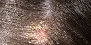 Then, rinse the shampoo and excess hair dye out with cool to warm water. How To Treat Scalp Scabs Kelture Aveda Best Hair Salon In Singapore