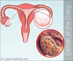 If you have to go to the bathroom often, it could be a sign of ovarian cancer. Quiz On Ovarian Cancer Cancer Of The Ovary