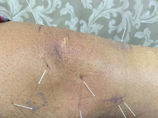 Dry needling for knee pain product image