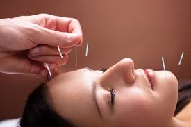 Image result for Acupuncture