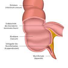 Blinddarmreizung Symptome Und Therapie Heilpraxis