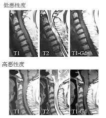 腫瘍の種類によって、薬の種類や投与期間も異なりますので、よく専門の先生と相談してください。 治療を受けるときには、自分の腫瘍が病理学的に、あるいは画像検査からどういう腫瘍が疑われるのかを知っておくことが大切です。 希少がんセンター 脳脊髄腫瘍担当 成田 善孝（なりた よしたか）. è„Šé«„è…«ç˜ Kompas