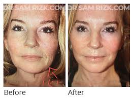 Chin Implant Patient Gallery