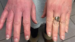 Tips For Managing Complex Regional Pain Syndrome Acep Now