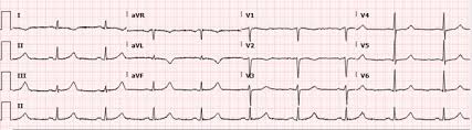 Prolonged Qtc Interval In Stress Induced Takotsubo Cardiomyopathy