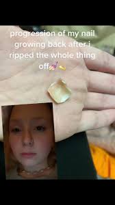 Acrylic Nails Ripping Off: Nail Growth Progression